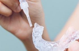 ホームホワイトニングによる色調管理