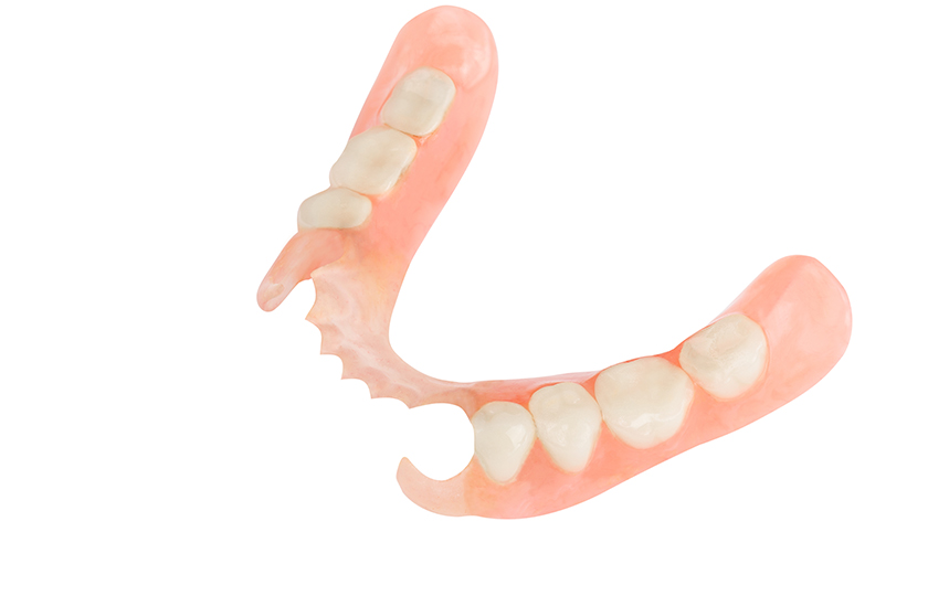 ばねが目立ちにくい入れ歯